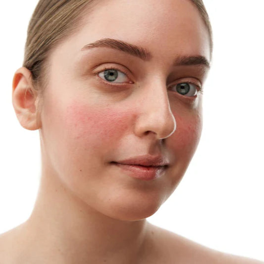 Azelaino rūgšties kremas nuo raudonio, 30 ml. Aktyvusis kremas raustančiai arba spuoguotai veido odai., pH 4,5-5.