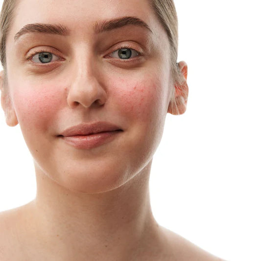 Raminamasis serumas nuo raudonio, 30 ml. Serumas rožinės pažeistai ir jautriai veido odai, pH 4,5-5,0